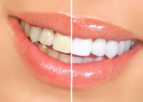 sbiancamento-denti-mascherine